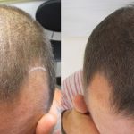 hair transplants USA