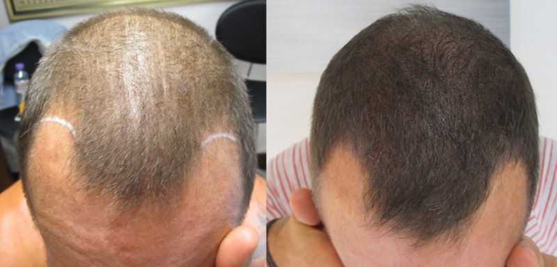 hair transplants USA