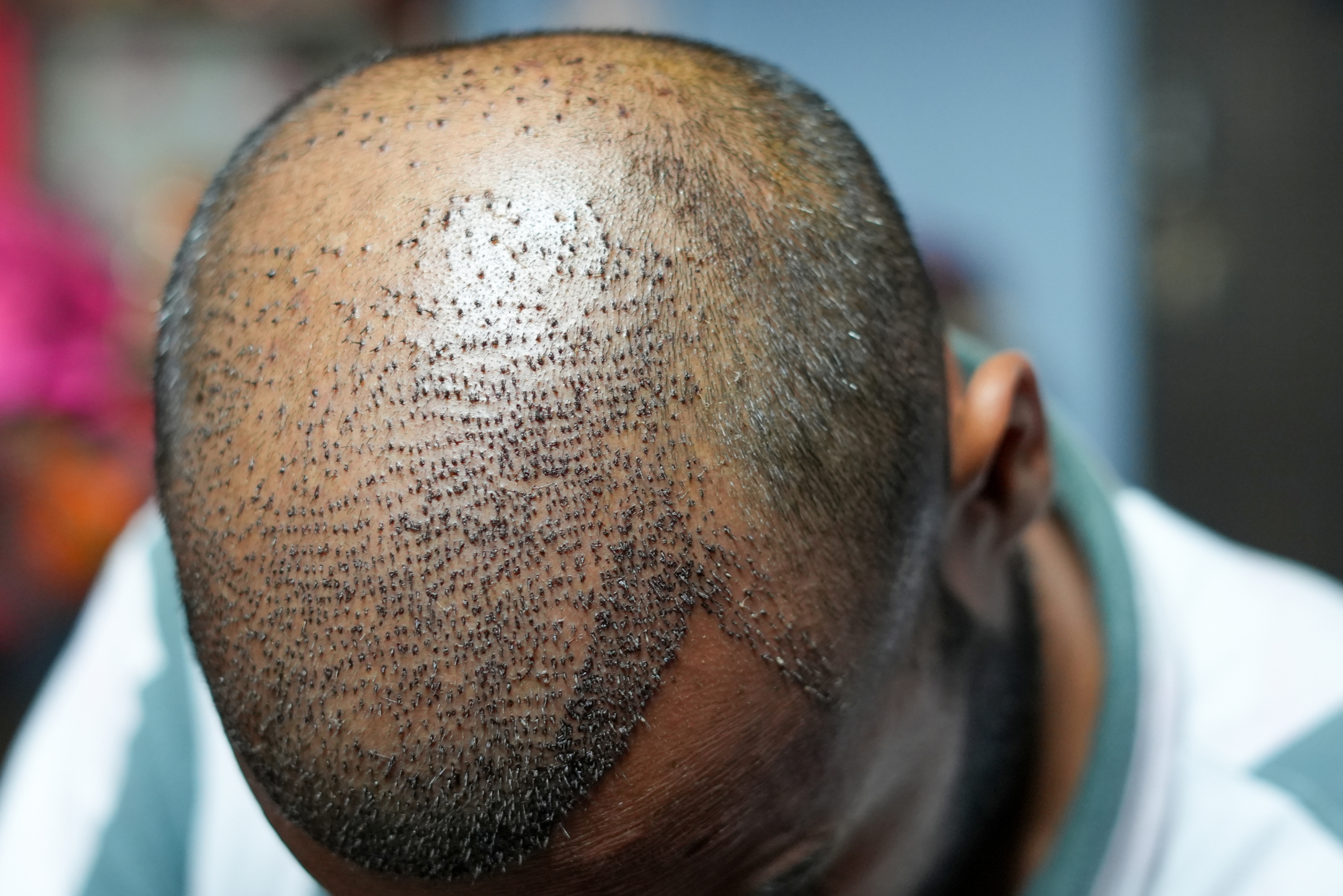 Is Trkiye Good For Hair Transplant?